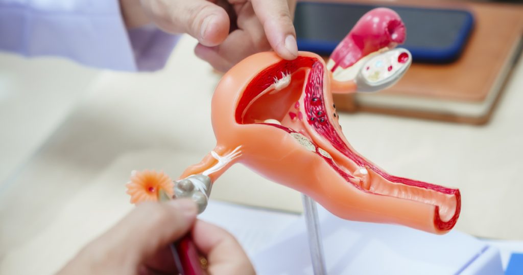 Endometriosis vs. adenomiosis